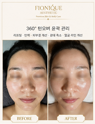 360° 컨투어 리프팅 관리후기