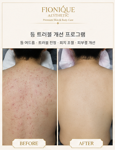 문제성 바디 케어 Before and After