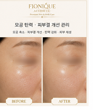 L 플라즈마 패키지 Before and After